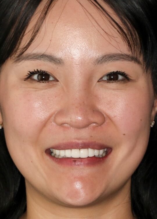 After — straight aligned smile with Invisalign at Paulus Dental