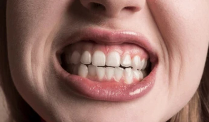 After — complete smile makeover with Invisalign at Paulus Dental