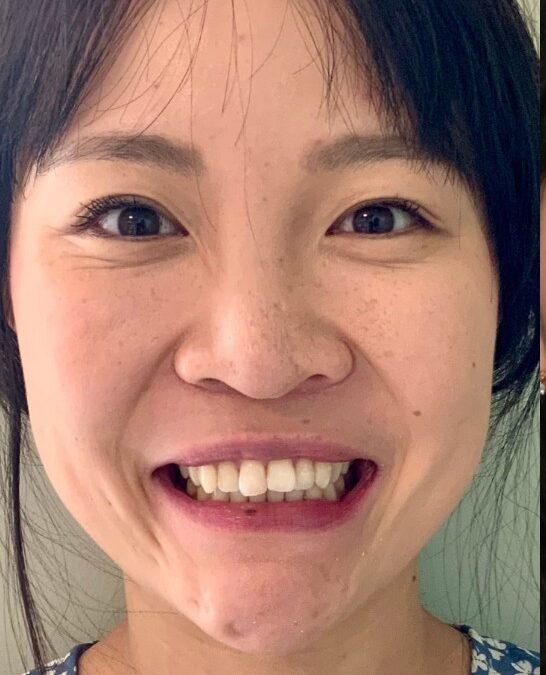 Before — crowded teeth correction with Invisalign at Paulus Dental