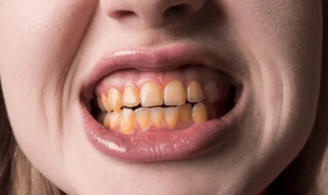 Before — bite correction with Invisalign at Paulus Dental