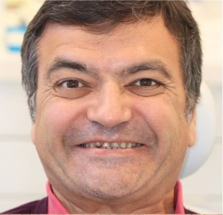 Before — gap closure with Invisalign at Paulus Dental